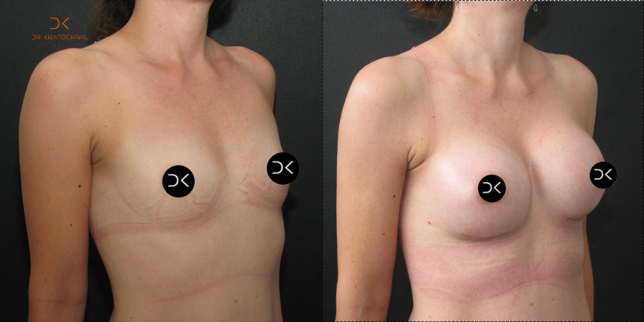 szablon przed po 500x1000