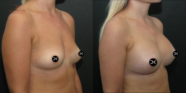 szablon przed po 500x1000