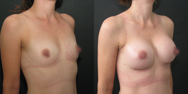 szablon przed po 500x1000