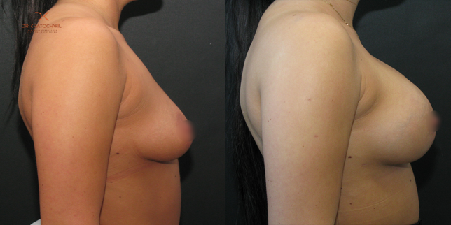 szablon przed po 500x1000