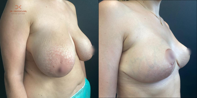 szablon przed po 500x1000