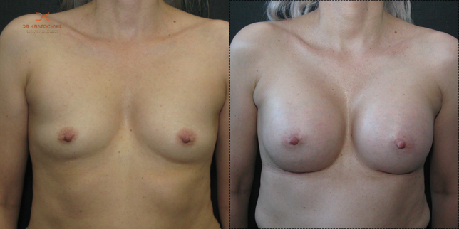 szablon przed po 500x1000