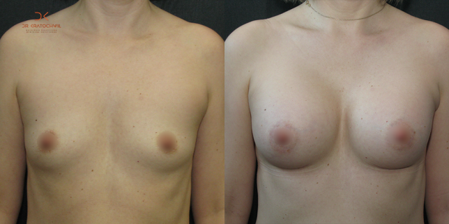 szablon przed po 500x1000