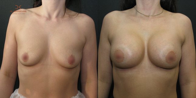 szablon przed po 500x1000