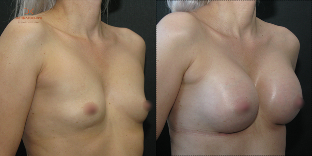 szablon przed po 500x10002